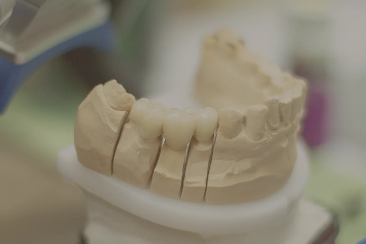 Impronta dentale per la realizzazione di una protesi fissa al Centro Medico 75 di Acqui Terme