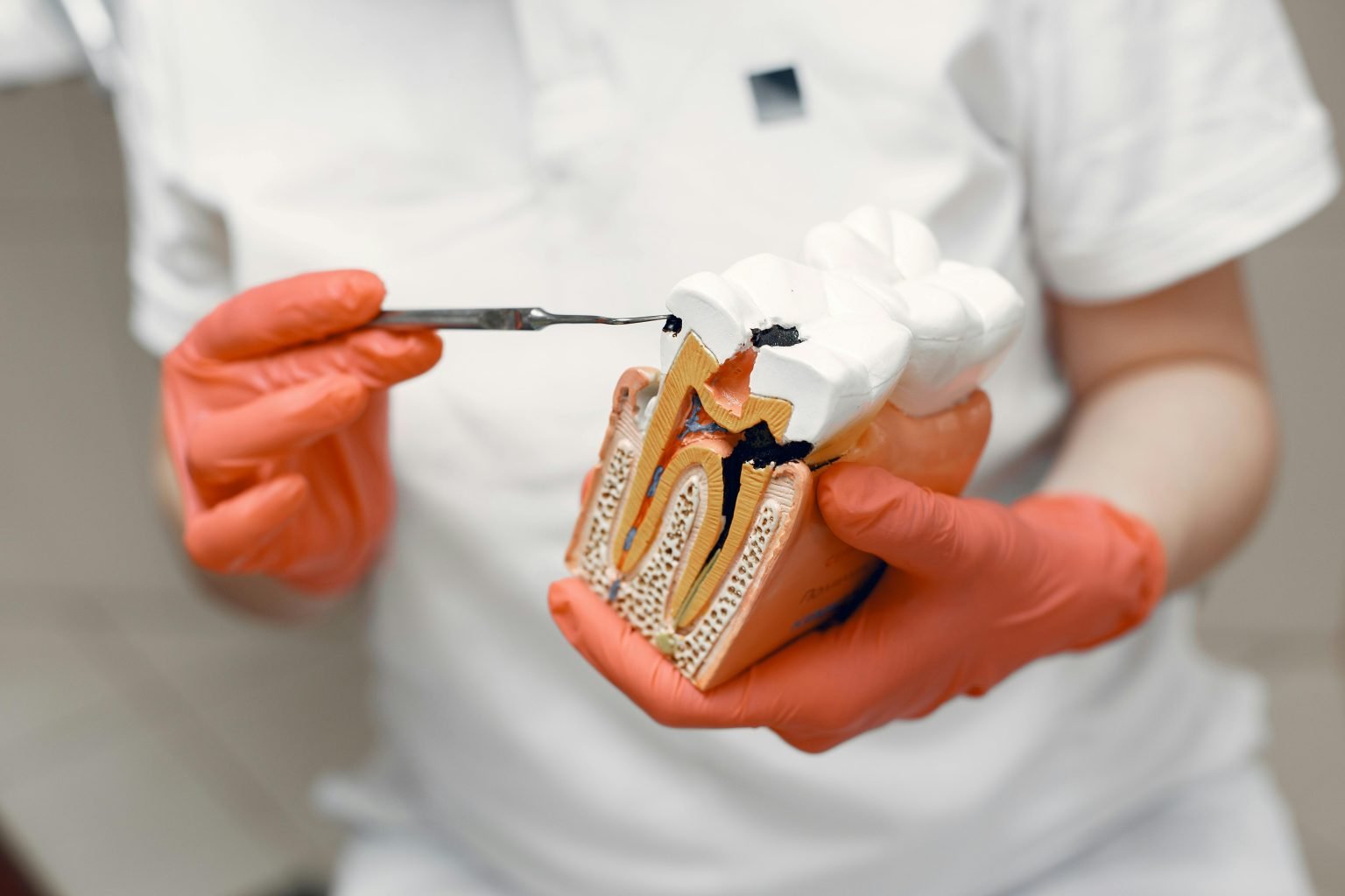 Dentista che mostra un modello dentale con carie per spiegare il trattamento endodontico